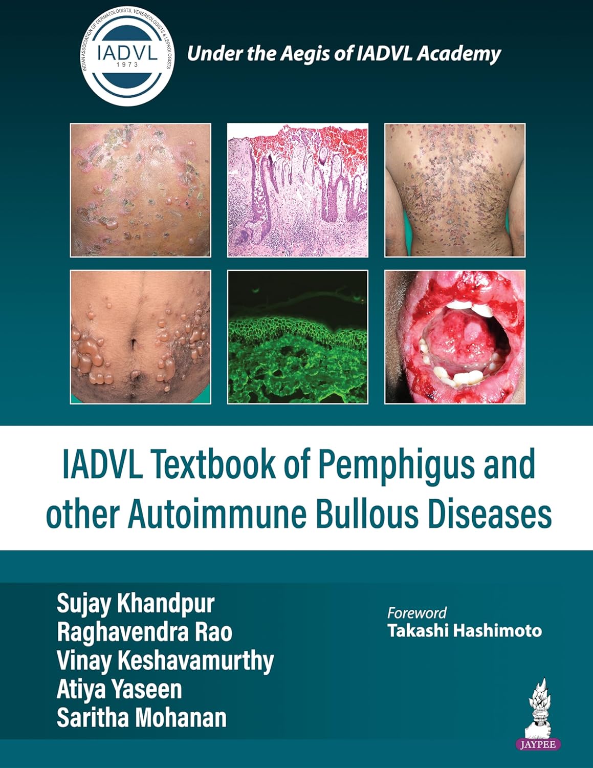 Iadvl Textbook of Pemphigus and Other Autoimmune Bullous Diseases