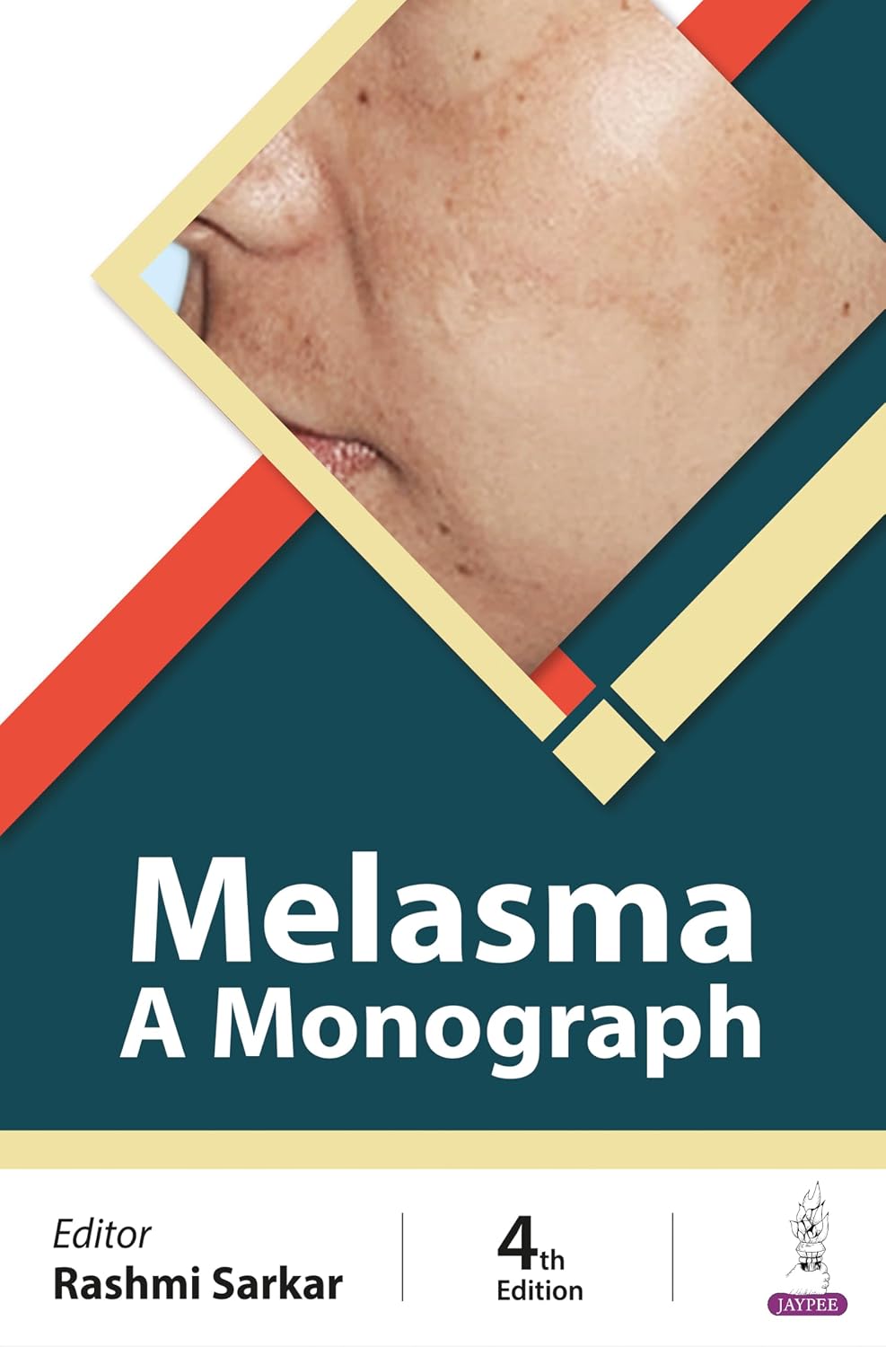 Melasma: a Monograph