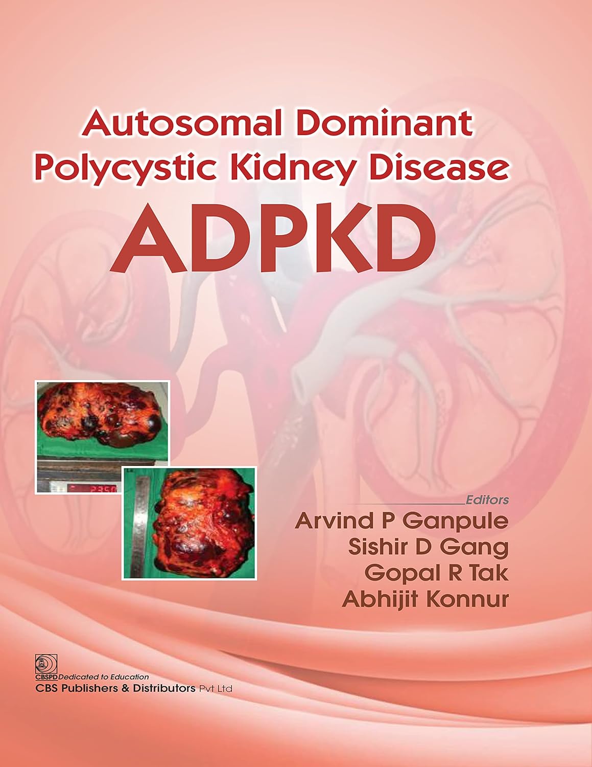 Autosomal Dominant Polycystic Kidney Disease Adpkd (Flexibond 2022)