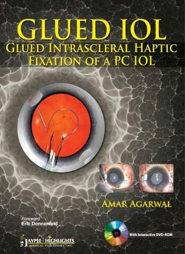 Glued Iol Glued Intrascleral Haptic Fixation Of A Pc Iol