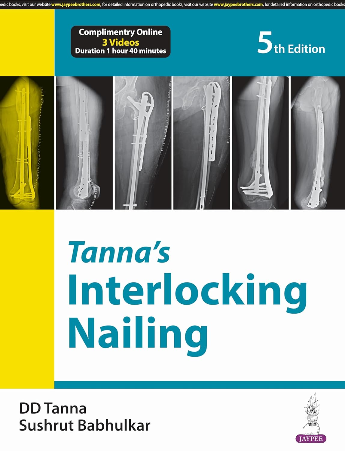 Tanna'S Interlocking Nailing