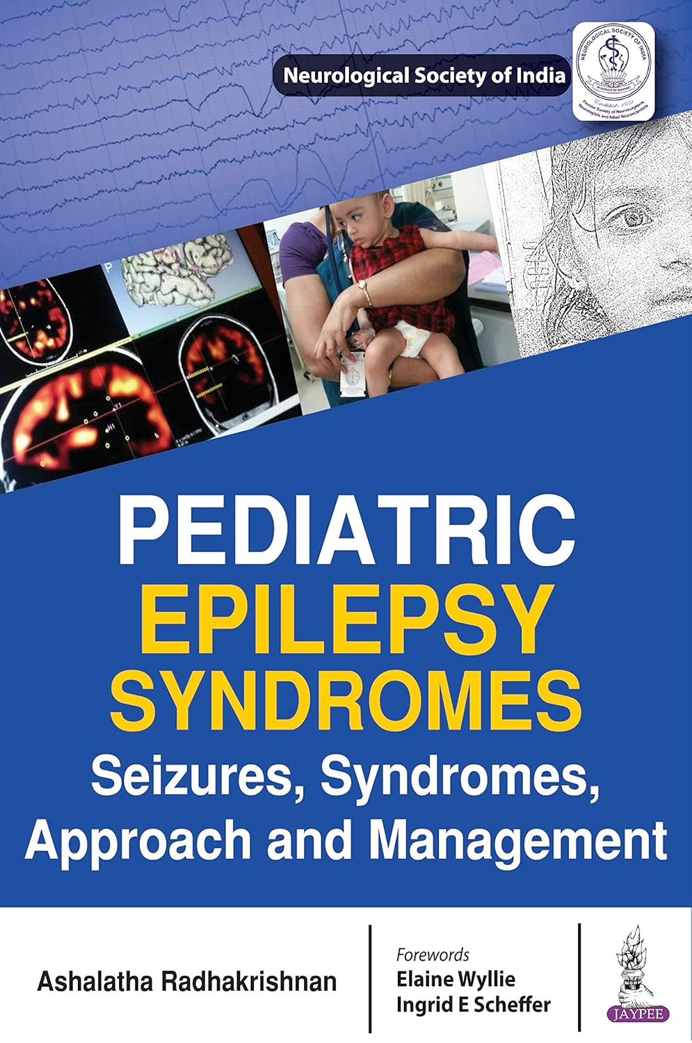 Pediatric Epilepsy Syndromes Seizures, Syndromes, Approach and Management