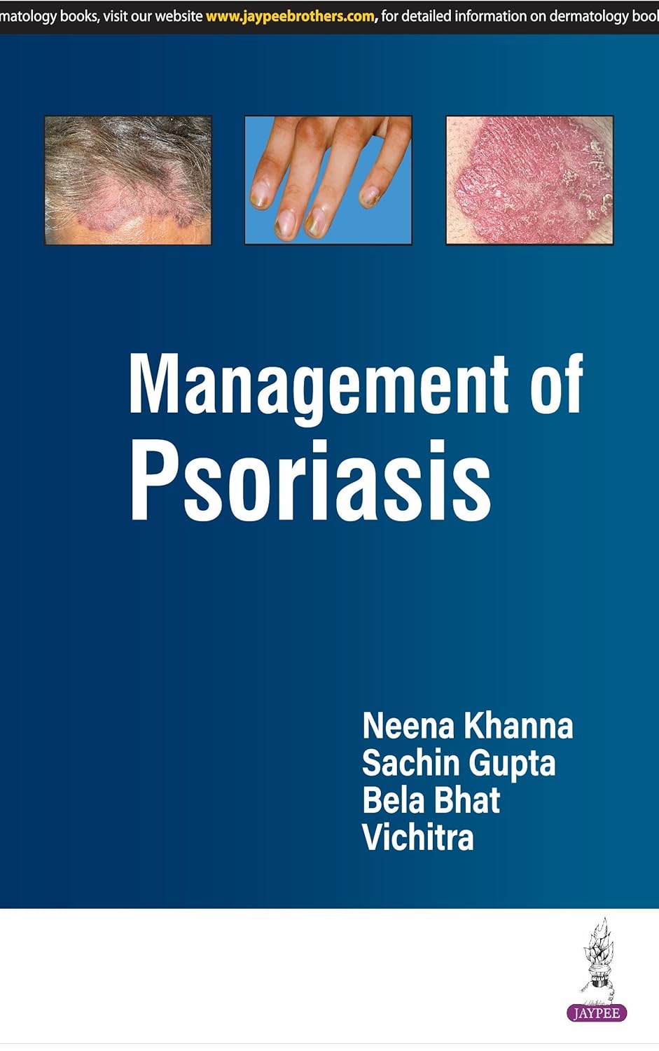 Management of Psoriasis