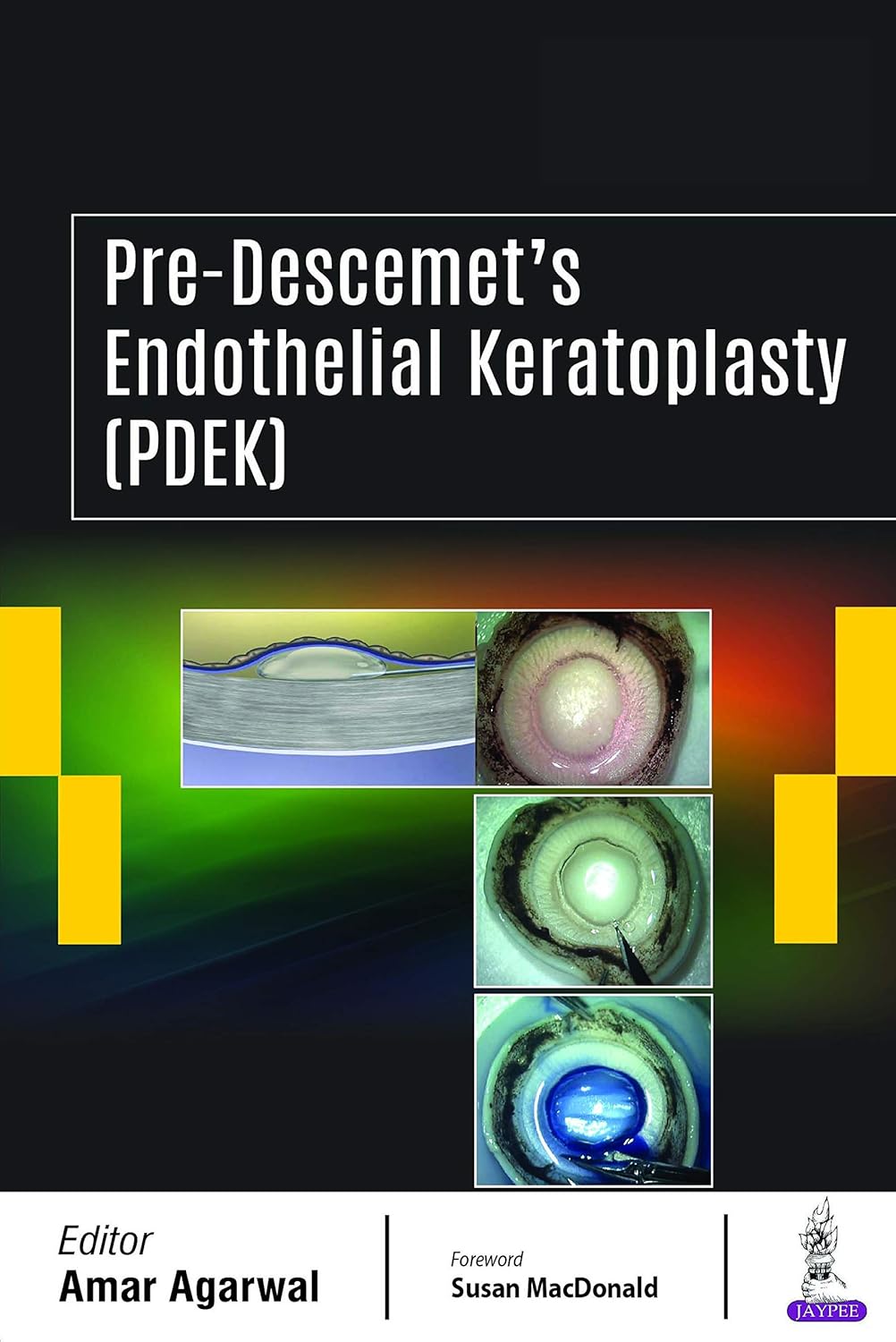 Pre-Descemet'S Endothelial Keratoplasty(Pdek)